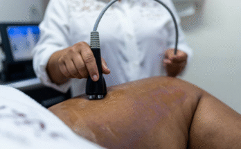 Varicose Veins