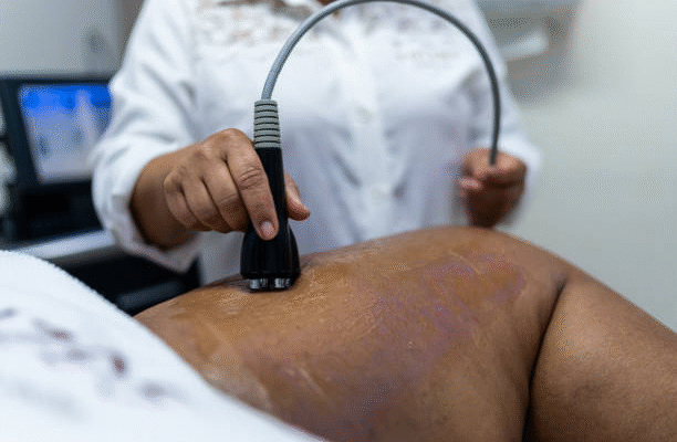 Varicose Veins